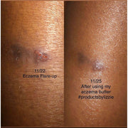 Lizzie's All-natural Products Lizzies All Natural Eczema Butter