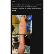 Lizzie's All-natural Products Lizzies All Natural Eczema Butter