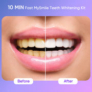 MySmile Ultimate Teeth Whitening Kit with 28X LED Light Teeth Whitening