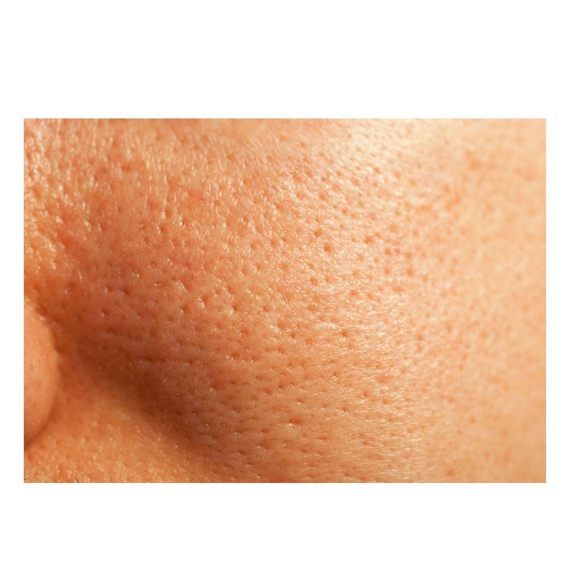 gymsegbë Thick As Thieves Pure Glycolic Acid Lactic Acid Extreme Gel Peel - 30ml Exfoliation, Dark Spots, Hyperpigmentation