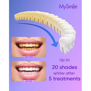 MySmile Ultimate Teeth Whitening Gel Refill 35%CP Teeth Whitening