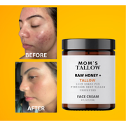 Mom’s Tallow Skin Serenity Face Cream – Nourishing Balm for Sensitive & Flaky Skin