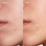 Maree Invisible Pimple & Acne Patches Build Your Bundle