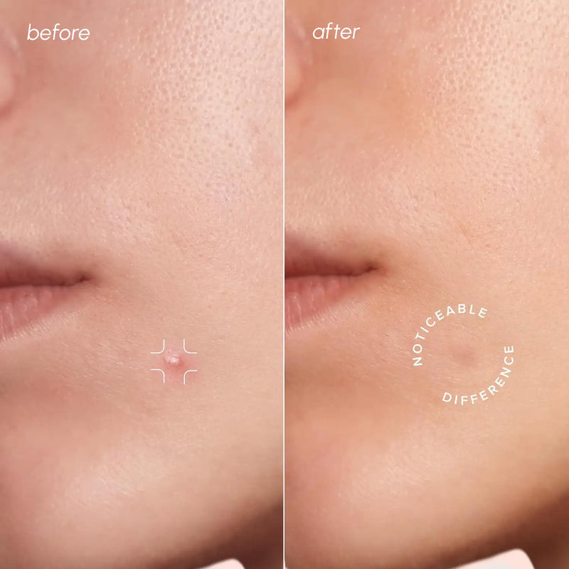 Maree Invisible Pimple & Acne Patches Build Your Bundle