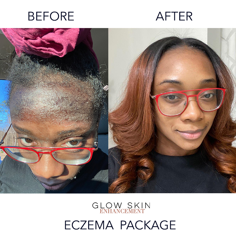 Glow Skin Enhancement ECZEMA RELIEF PACKAGE (Real Results) Eczema Care