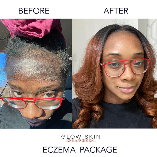 Glow Skin Enhancement ECZEMA RELIEF PACKAGE (Real Results) Eczema Care