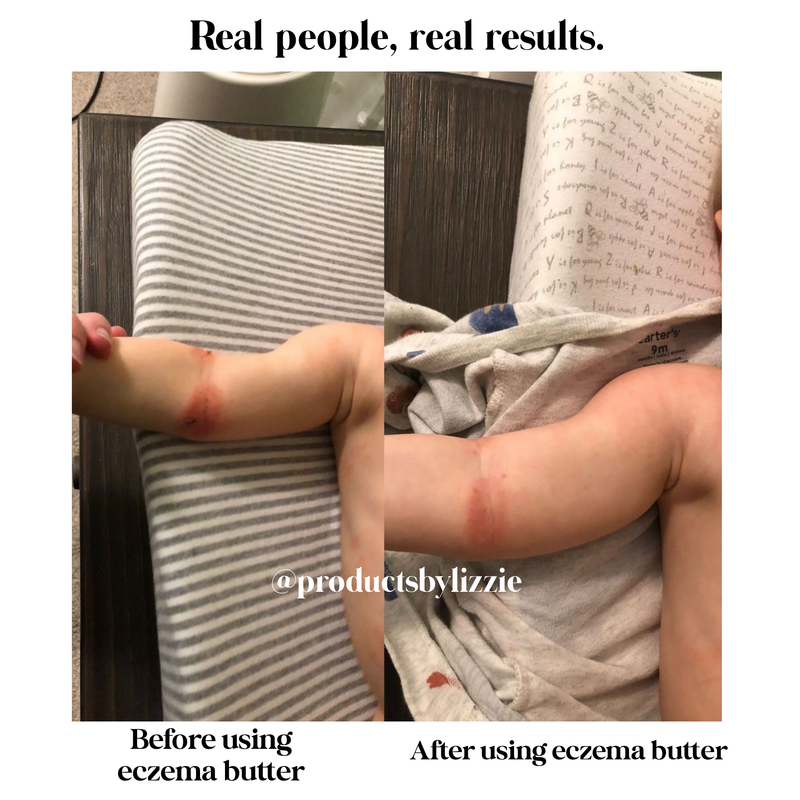 Lizzie's All-natural Products Lizzies All Natural Eczema Butter
