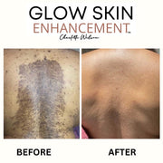 Glow Skin Enhancement ECZEMA RELIEF PACKAGE (Real Results) Eczema Care