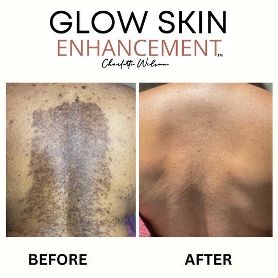 Glow Skin Enhancement ECZEMA RELIEF PACKAGE (Real Results) Eczema Care
