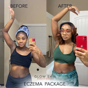 Glow Skin Enhancement ECZEMA RELIEF PACKAGE (Real Results) Eczema Care