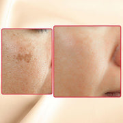 gymsegbë The Eraser Spot Cream | Dark Spot Corrector Dark Spots, Hyperpigmentation