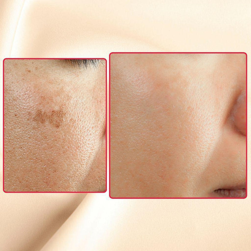 gymsegbë The Eraser Spot Cream | Dark Spot Correcting Moisturizer Dark Spots, Hyperpigmentation Antique White 1 Bottle,2 Bottles,3 Bottles,4 Bottles