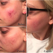 Timeless Organics Skin Care 3-Step Acne System Kit