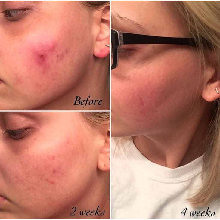 Timeless Organics Skin Care 3-Step Acne System Kit