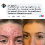 BALLBOYZ MVP Face Acne Scrubs