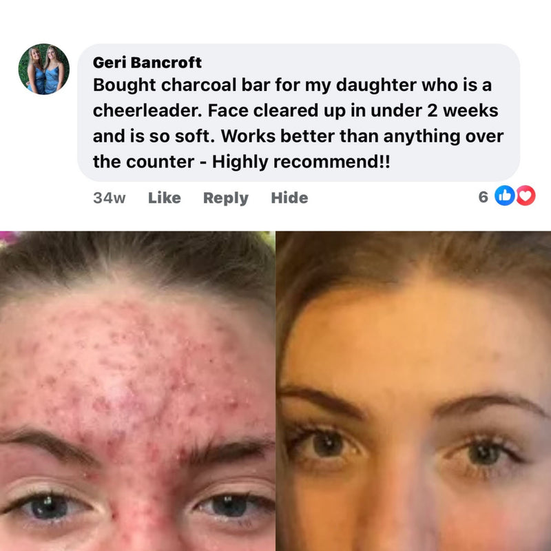 BALLBOYZ MVP Face Acne Scrubs