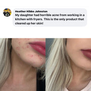 BALLBOYZ MVP Face Acne Scrubs