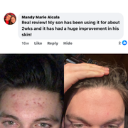 BALLBOYZ MVP Face Acne Scrubs