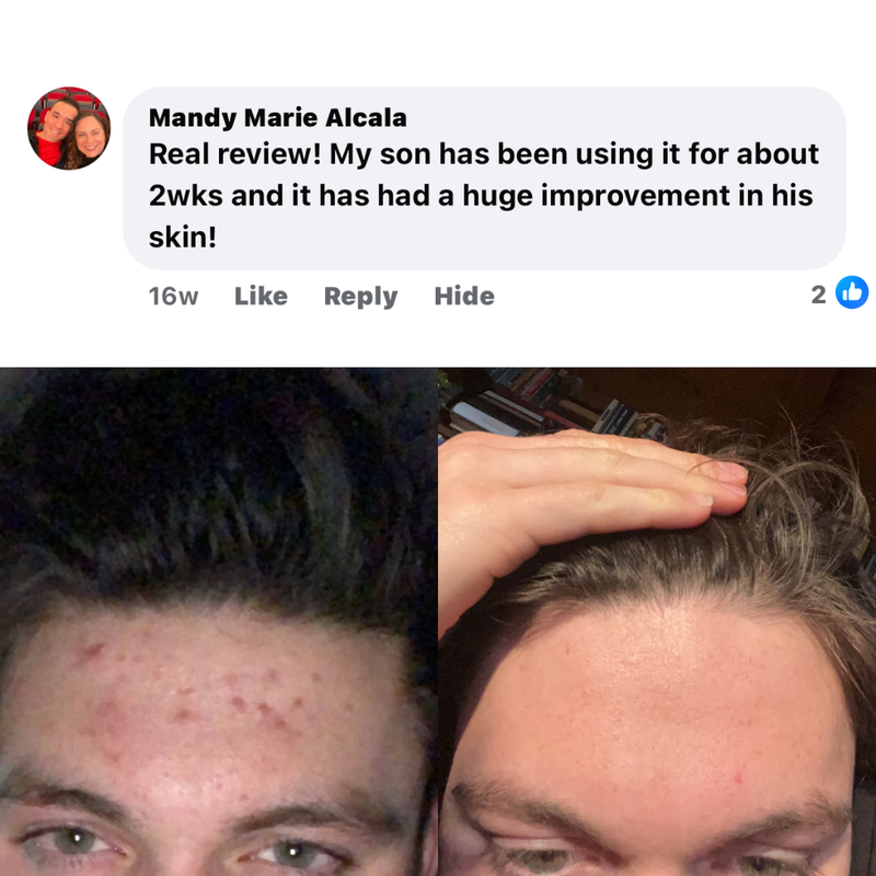 BALLBOYZ MVP Face Acne Scrubs