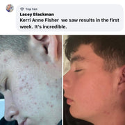 BALLBOYZ MVP Face Acne Scrubs