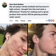 BALLBOYZ MVP Face Acne Scrubs