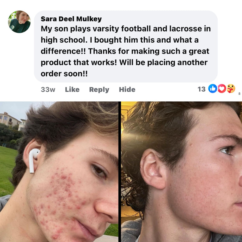 BALLBOYZ MVP Face Acne Scrubs