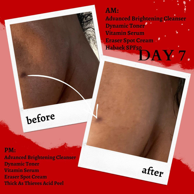 gymsegbë The Eraser Spot Cream | Dark Spot Corrector Dark Spots, Hyperpigmentation