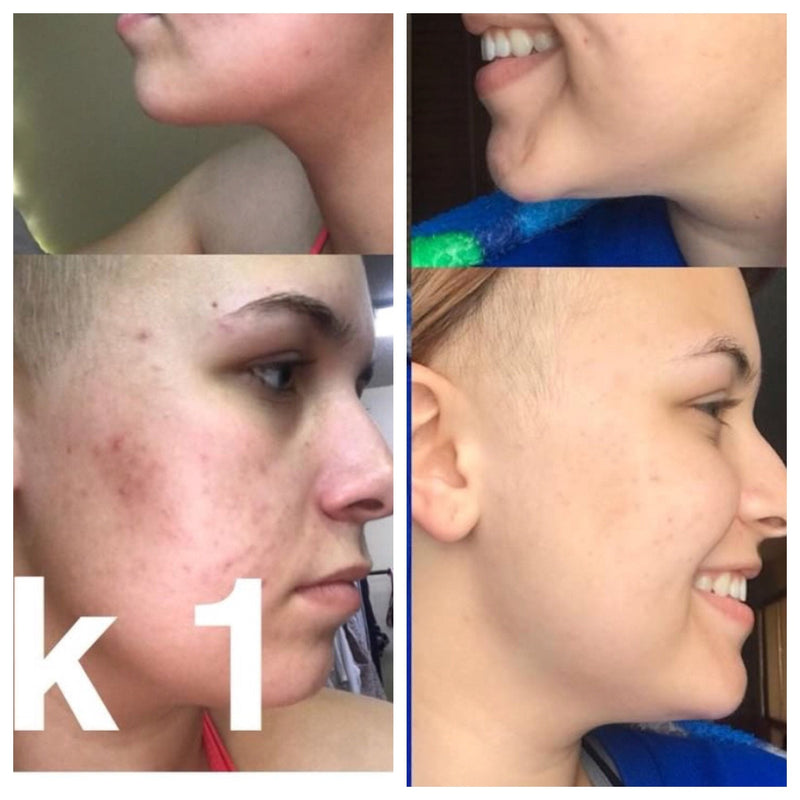 Butter Me Up Organics Super Acne Fighter / Organic Acne Treatment / Acne / Essential Oils / Natural  Acne Treatment / Acne Scars / Hormonal Acne / Cystic Acne Face