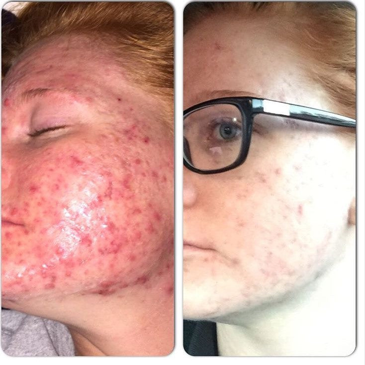 Timeless Organics Skin Care 3-Step Acne System Kit