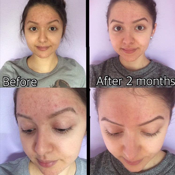 Timeless Organics Skin Care 3-Step Acne System Kit
