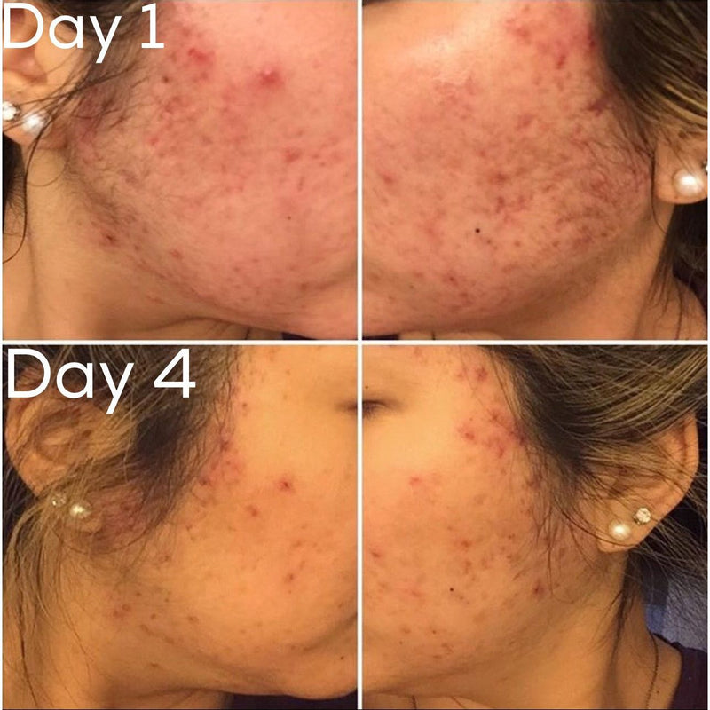 Timeless Organics Skin Care 3-Step Acne System Kit