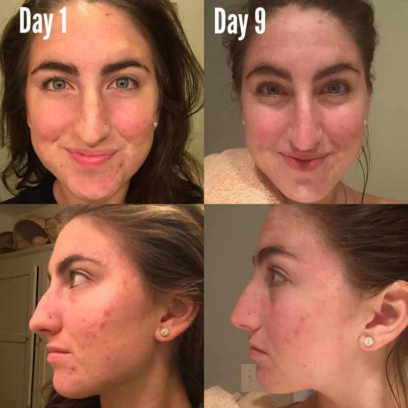 Timeless Organics Skin Care 3-Step Acne System Kit