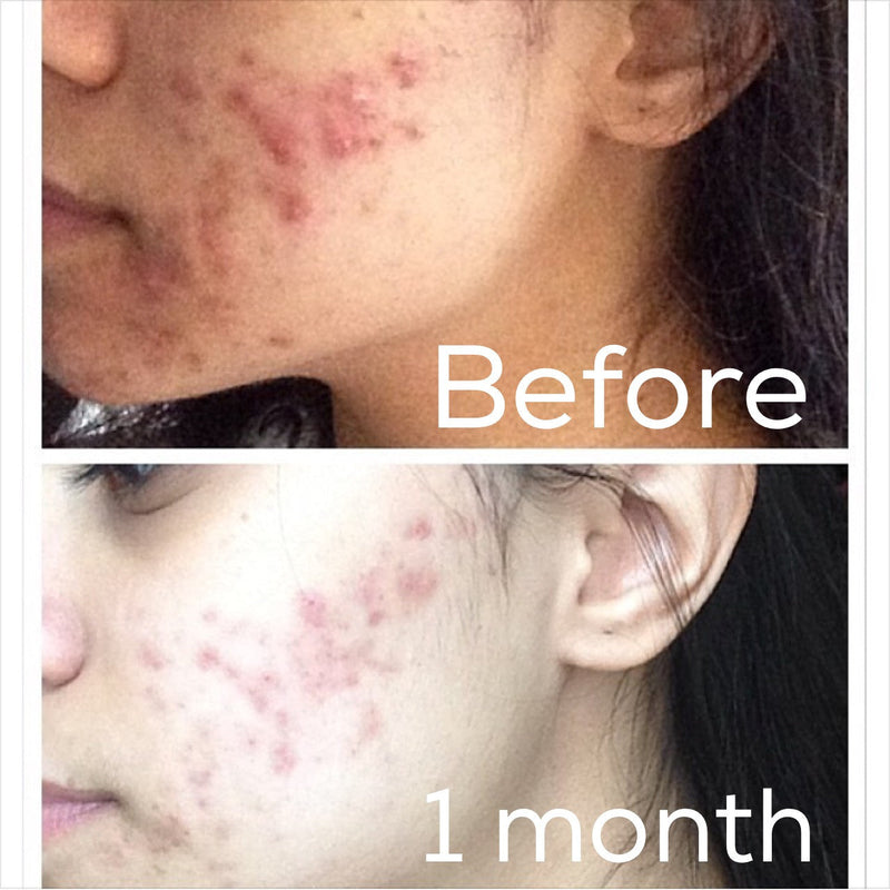 Timeless Organics Skin Care 3-Step Acne System Kit