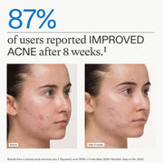 Nava Beauty Nutrafol Clear Skin Nutraceutical Acne Supplement 3-Month Supply White Smoke