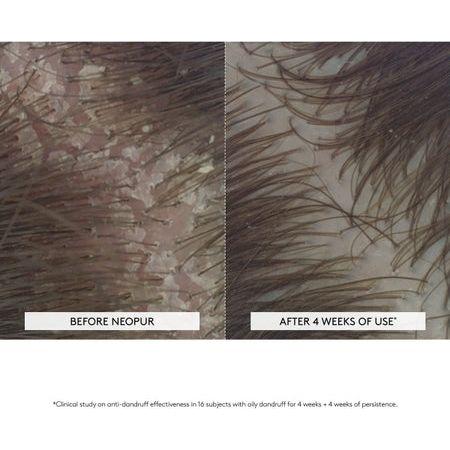 Rene Furterer Rene Furterer Neopur Anti-Dandruff Balancing Shampoo (Oily, Flaky Scalp) 150ml/5o Shampoo